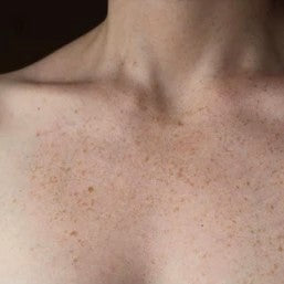 Freckles